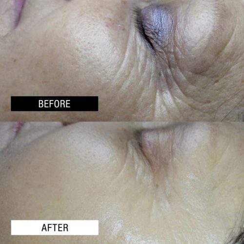Resurfacing pH formula