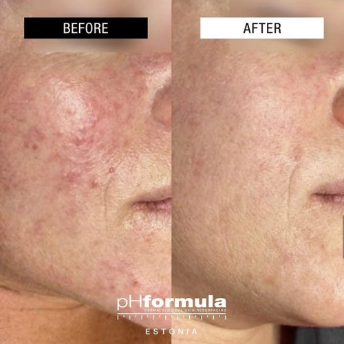 Resurfacing pH formula