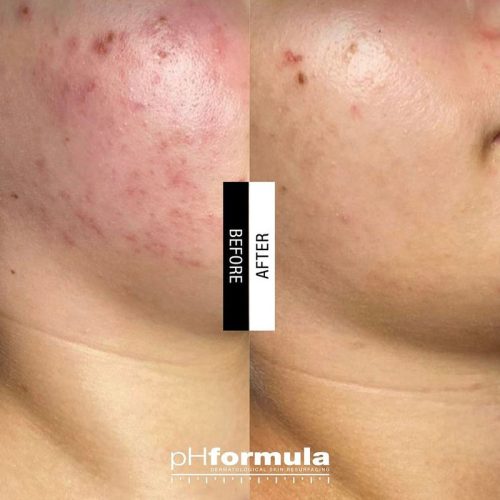 Resurfacing pH formula